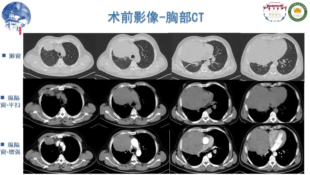 影像PPT - 【病例】纵隔大细胞神经内分泌癌1例CT影像-4