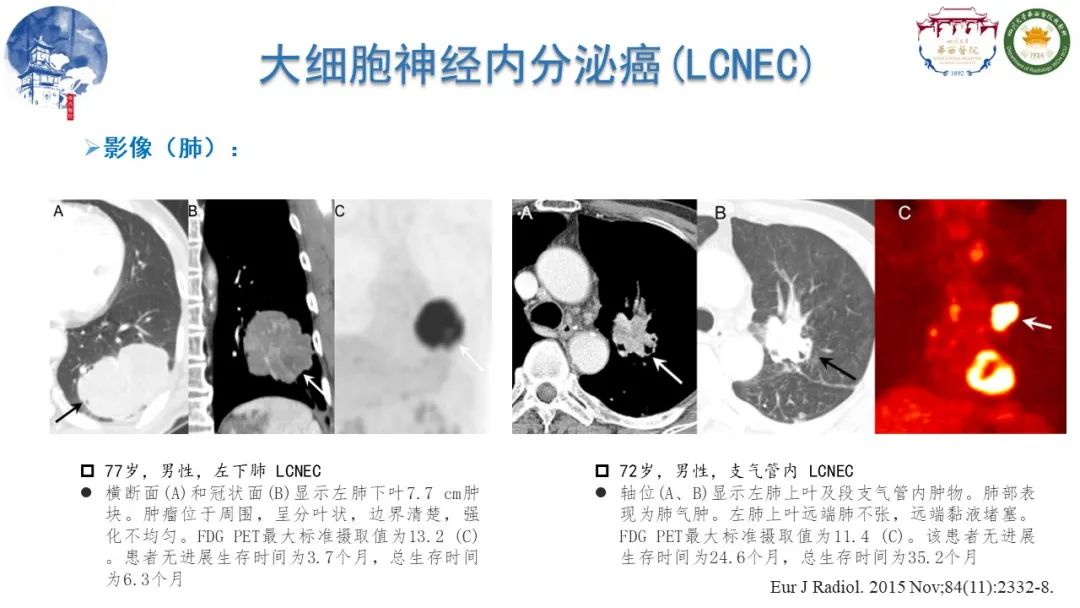 影像PPT - 【病例】纵隔大细胞神经内分泌癌1例CT影像-11