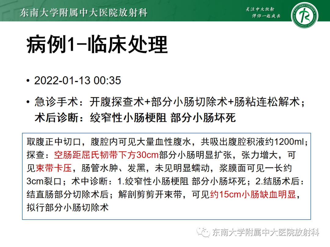 影像PPT - 【PPT】闭袢性小肠梗阻：CT征象评估的价值-5