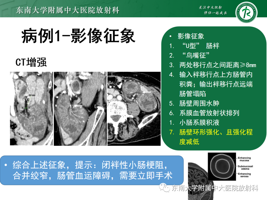影像PPT - 【PPT】闭袢性小肠梗阻：CT征象评估的价值-4
