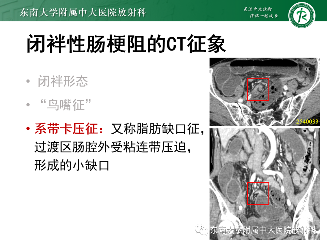 影像PPT - 【PPT】闭袢性小肠梗阻：CT征象评估的价值-12