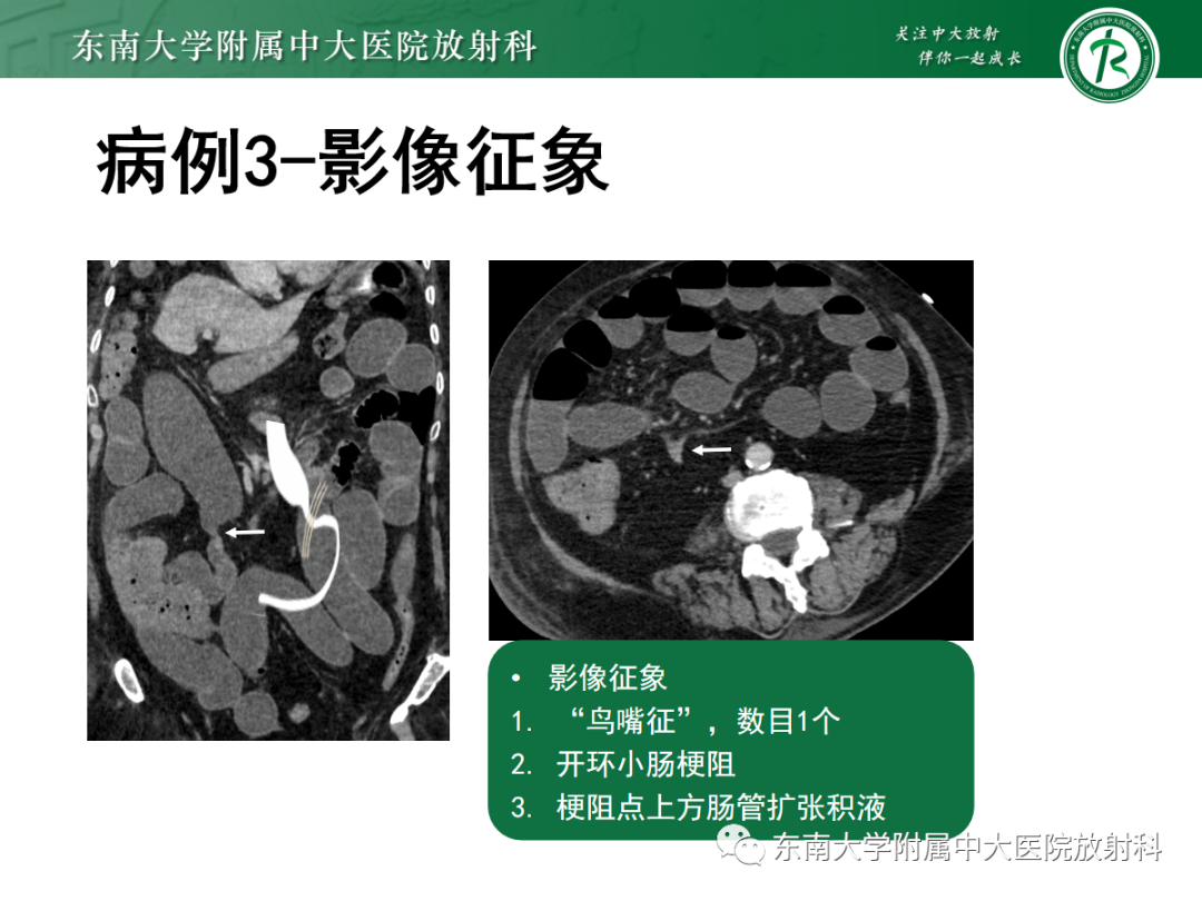 影像PPT - 【PPT】闭袢性小肠梗阻：CT征象评估的价值-17