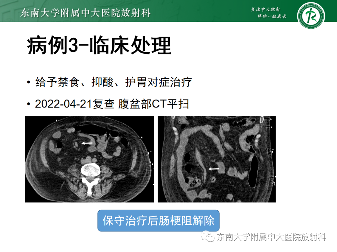 影像PPT - 【PPT】闭袢性小肠梗阻：CT征象评估的价值-18