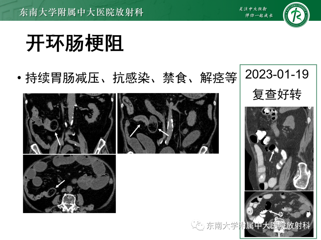 影像PPT - 【PPT】闭袢性小肠梗阻：CT征象评估的价值-19