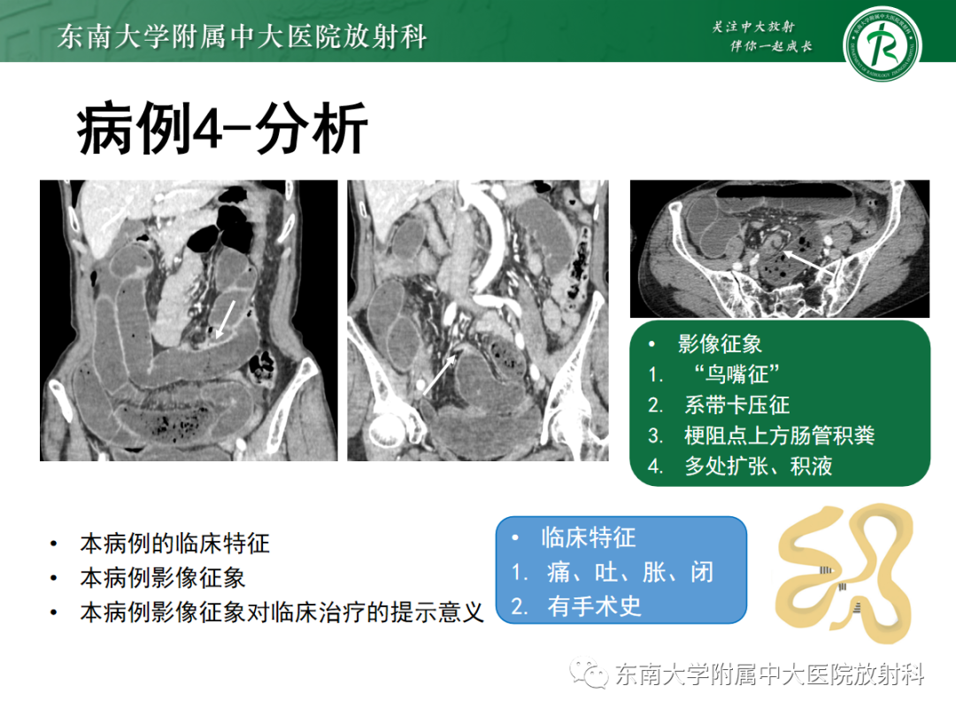 影像PPT - 【PPT】闭袢性小肠梗阻：CT征象评估的价值-21