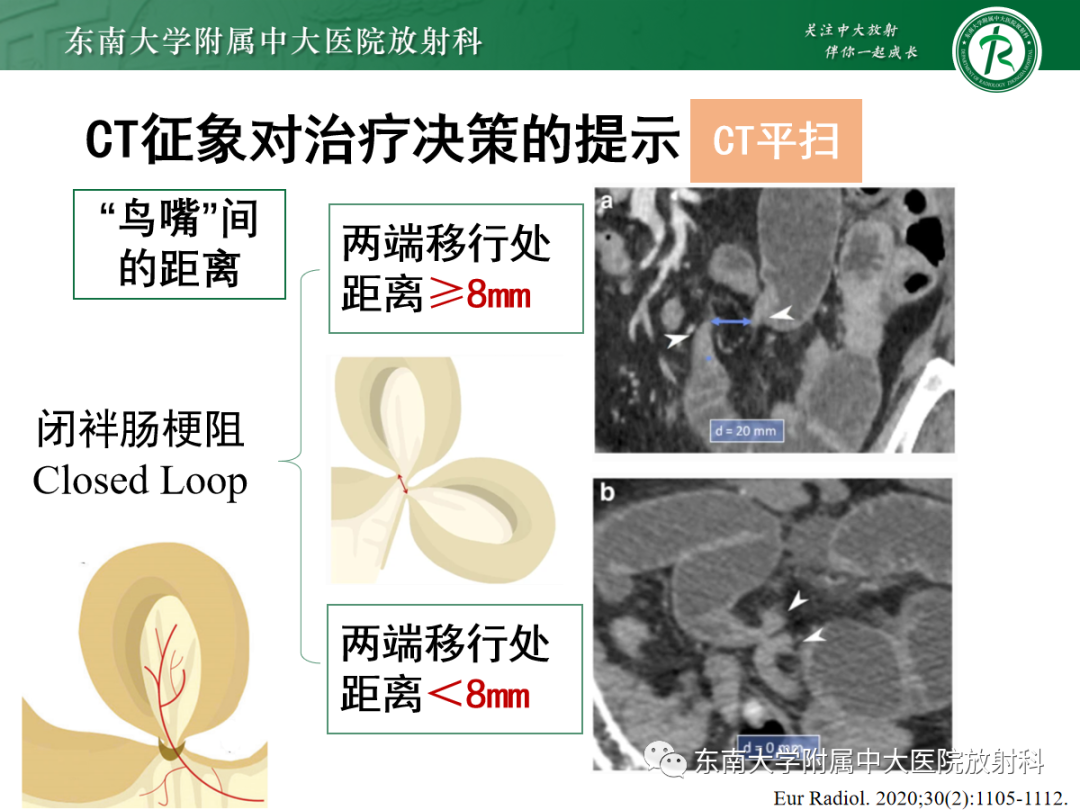 影像PPT - 【PPT】闭袢性小肠梗阻：CT征象评估的价值-24