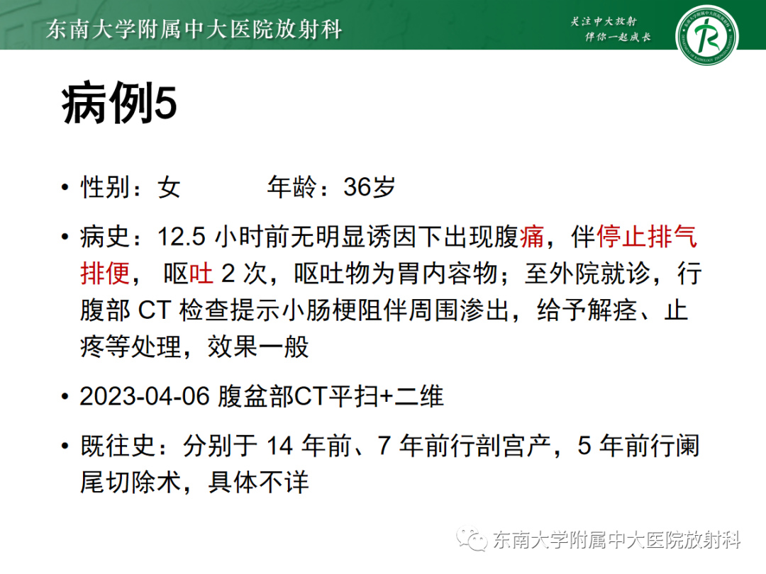 影像PPT - 【PPT】闭袢性小肠梗阻：CT征象评估的价值-26