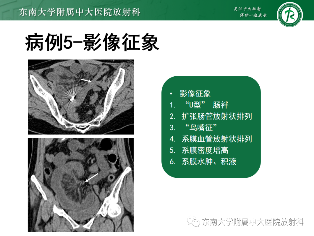 影像PPT - 【PPT】闭袢性小肠梗阻：CT征象评估的价值-27