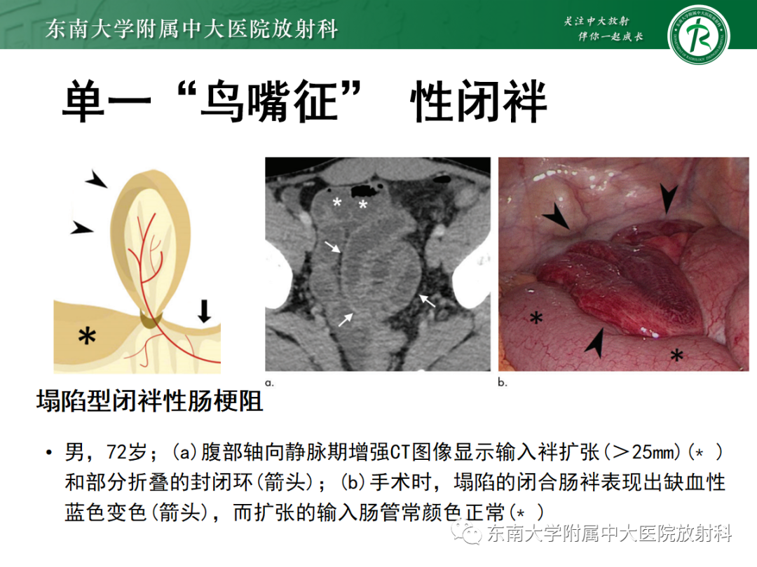 影像PPT - 【PPT】闭袢性小肠梗阻：CT征象评估的价值-32
