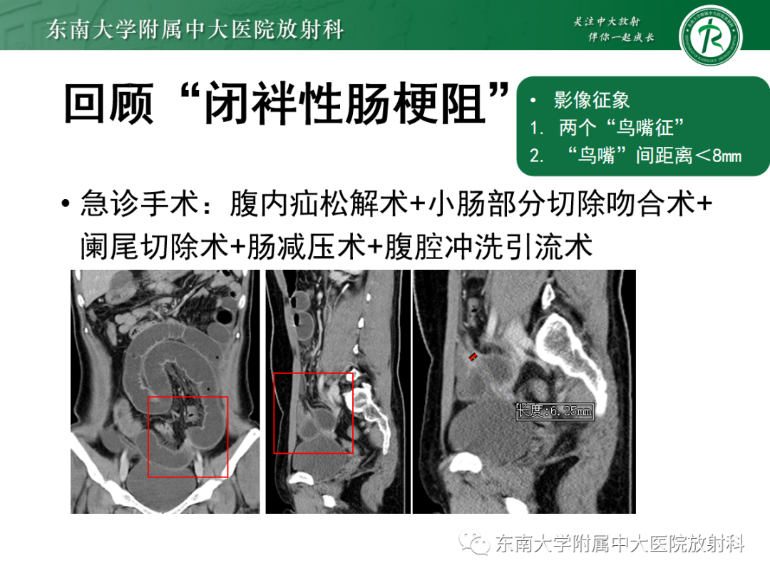 影像PPT - 【PPT】闭袢性小肠梗阻：CT征象评估的价值-35