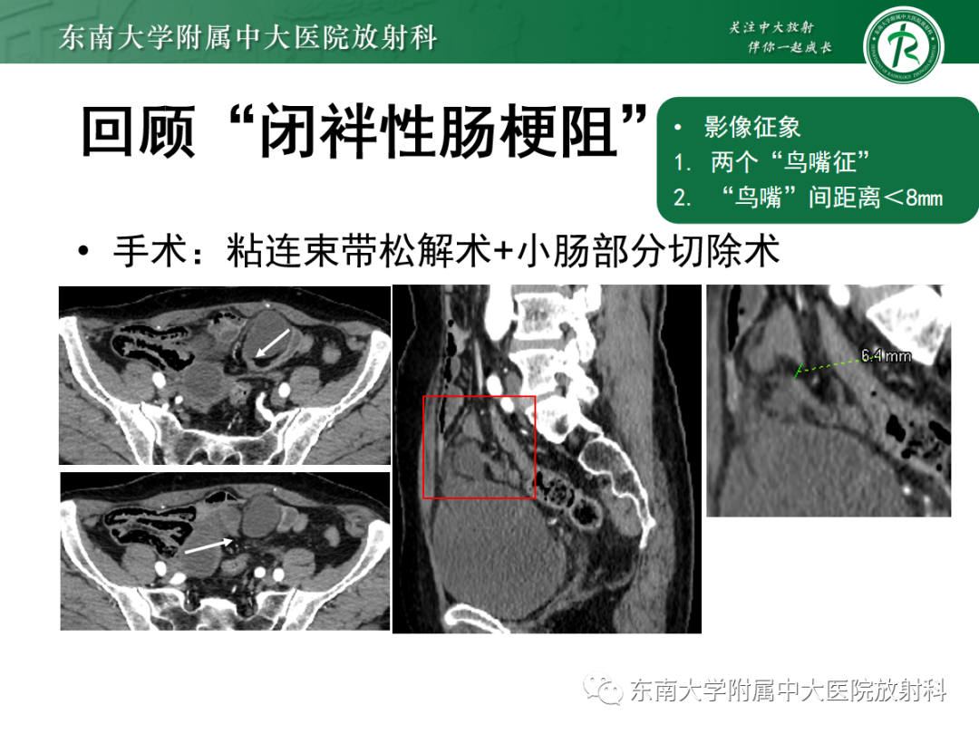 影像PPT - 【PPT】闭袢性小肠梗阻：CT征象评估的价值-36