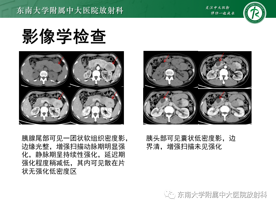 影像PPT - 【PPT】胰腺神经内分泌肿瘤-5 影像PPT - 【PPT】胰腺神经内分泌肿瘤-5