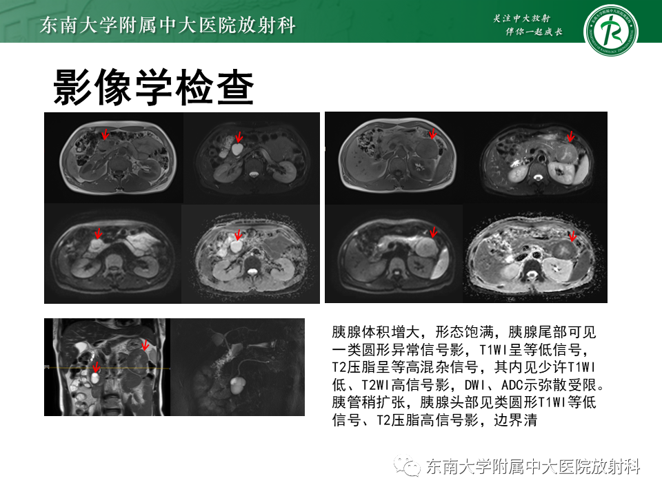 影像PPT - 【PPT】胰腺神经内分泌肿瘤-6 影像PPT - 【PPT】胰腺神经内分泌肿瘤-6