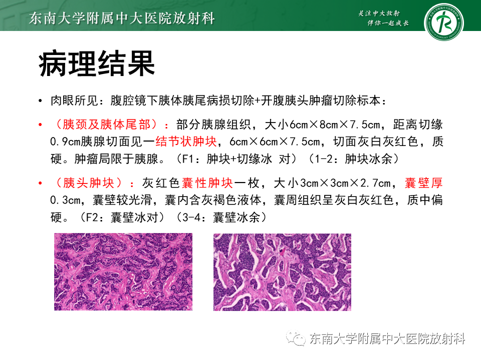 影像PPT - 【PPT】胰腺神经内分泌肿瘤-8 影像PPT - 【PPT】胰腺神经内分泌肿瘤-8