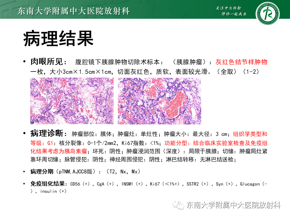 影像PPT - 【PPT】胰腺神经内分泌肿瘤-27 影像PPT - 【PPT】胰腺神经内分泌肿瘤-27