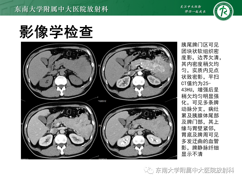 影像PPT - 【PPT】胰腺神经内分泌肿瘤-29 影像PPT - 【PPT】胰腺神经内分泌肿瘤-29