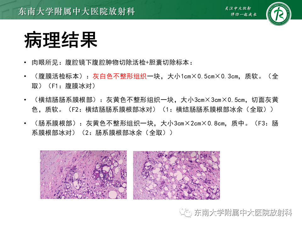 影像PPT - 【PPT】胰腺神经内分泌肿瘤-39 影像PPT - 【PPT】胰腺神经内分泌肿瘤-39