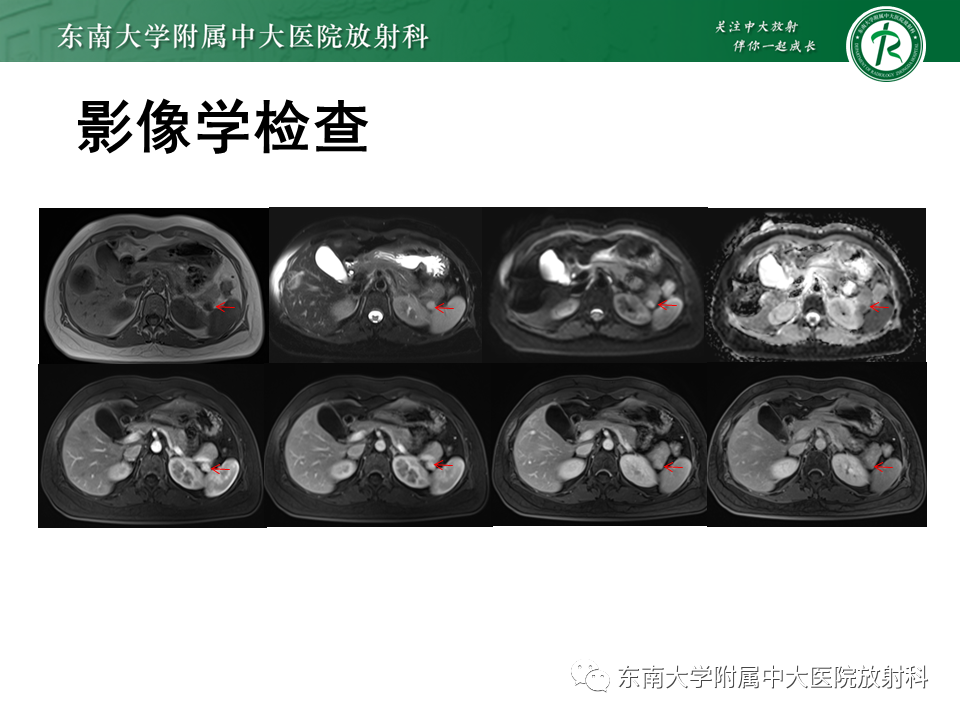 影像PPT - 【PPT】胰腺神经内分泌肿瘤-44 影像PPT - 【PPT】胰腺神经内分泌肿瘤-44