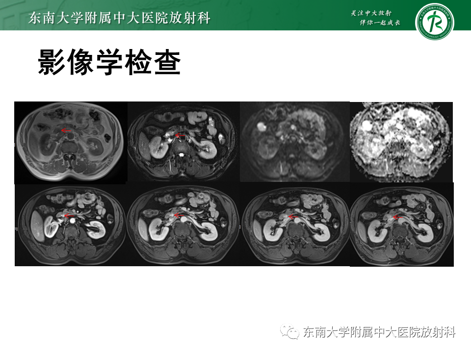 影像PPT - 【PPT】胰腺神经内分泌肿瘤-48 影像PPT - 【PPT】胰腺神经内分泌肿瘤-48