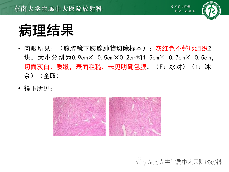 影像PPT - 【PPT】胰腺神经内分泌肿瘤-51 影像PPT - 【PPT】胰腺神经内分泌肿瘤-51