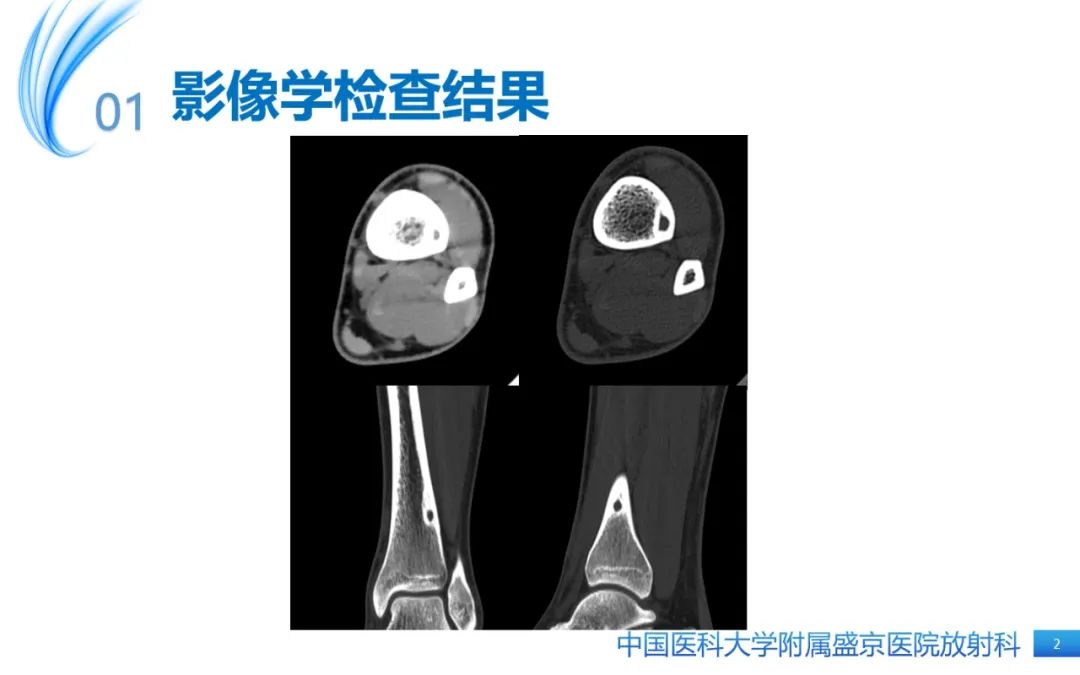影像PPT - 【PPT】骨样骨瘤-2
