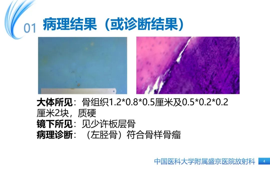 影像PPT - 【PPT】骨样骨瘤-4