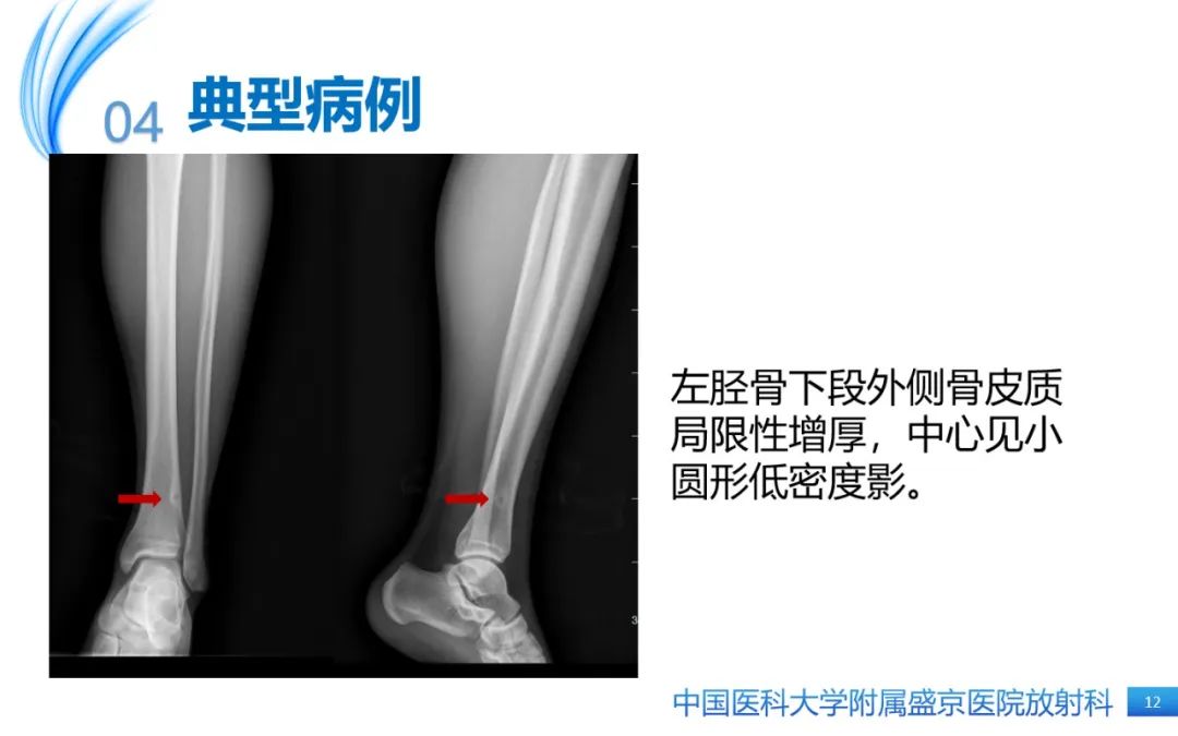 影像PPT - 【PPT】骨样骨瘤-12