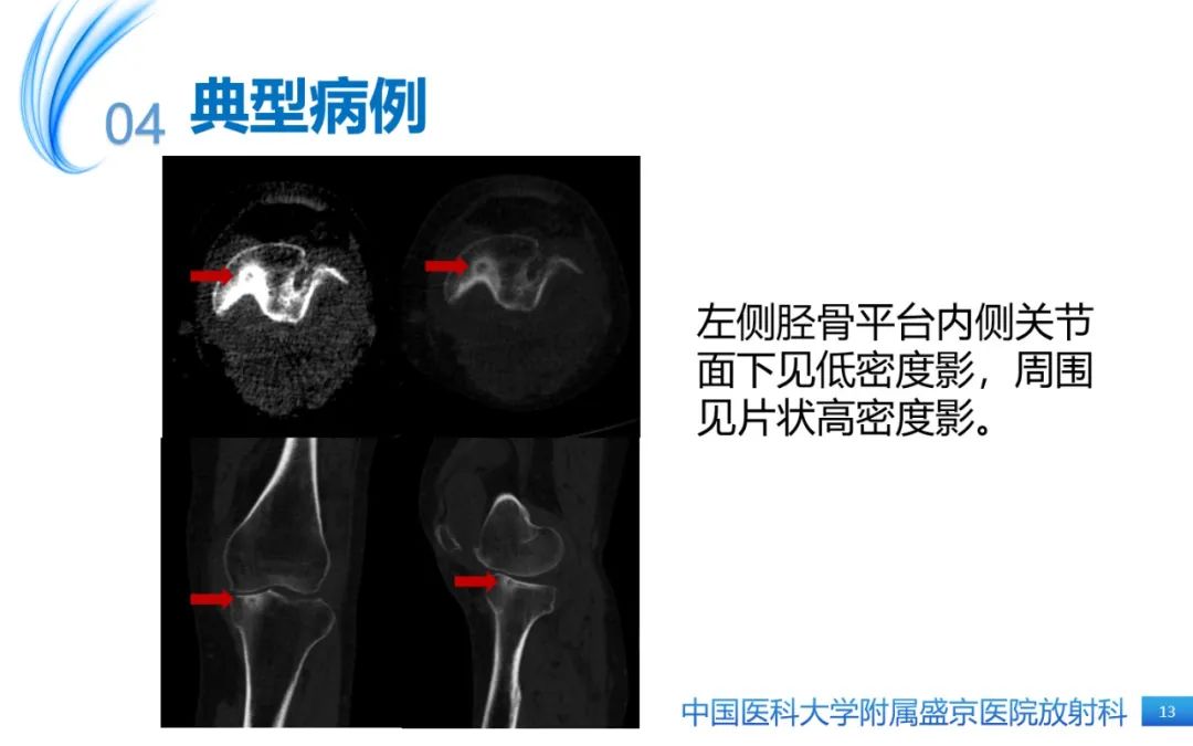 影像PPT - 【PPT】骨样骨瘤-13