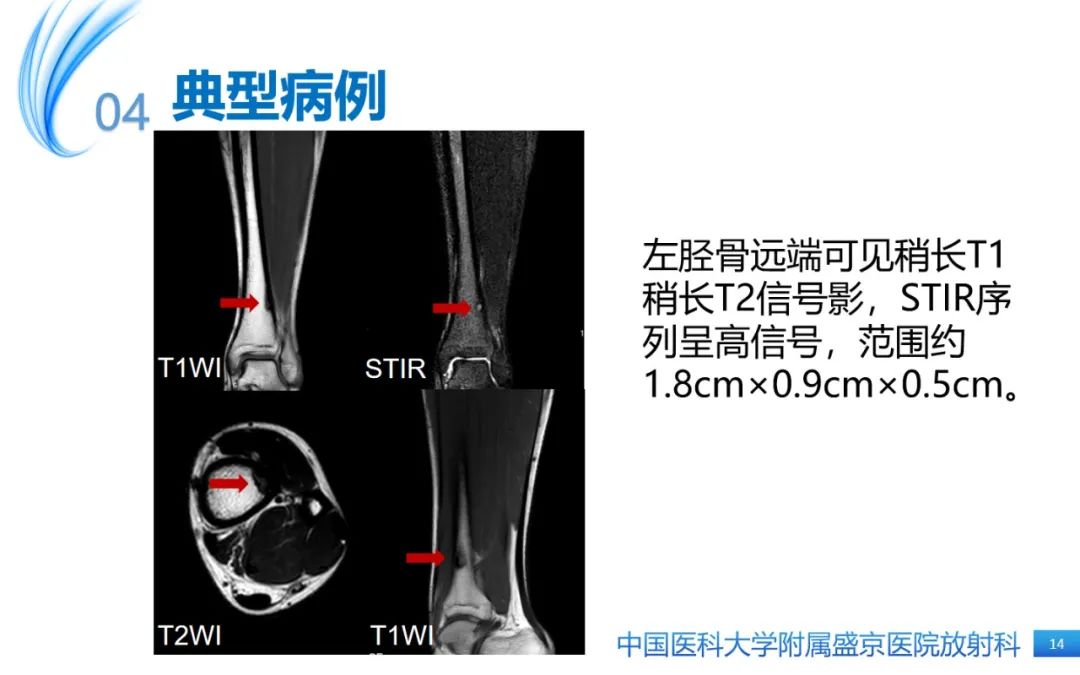 影像PPT - 【PPT】骨样骨瘤-14