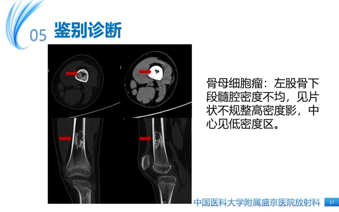 影像PPT - 【PPT】骨样骨瘤-17