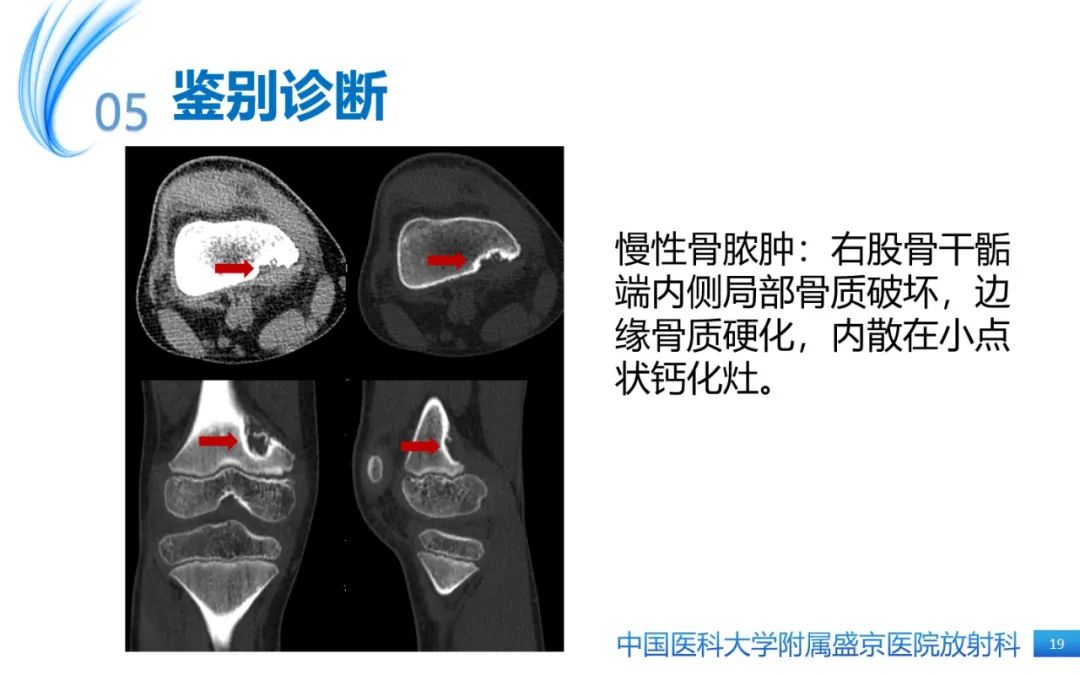 影像PPT - 【PPT】骨样骨瘤-19