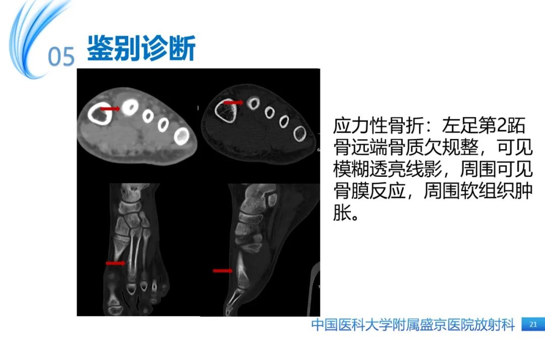 影像PPT - 【PPT】骨样骨瘤-21