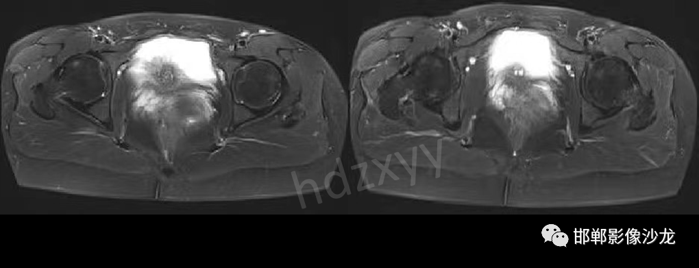 影像PPT - 【PPT】膀胱子宫内膜异位症-5 影像PPT - 【PPT】膀胱子宫内膜异位症-5