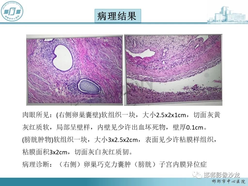 影像PPT - 【PPT】膀胱子宫内膜异位症-13 影像PPT - 【PPT】膀胱子宫内膜异位症-13