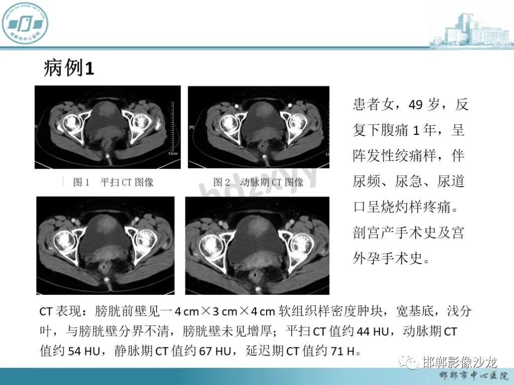 影像PPT - 【PPT】膀胱子宫内膜异位症-19 影像PPT - 【PPT】膀胱子宫内膜异位症-19