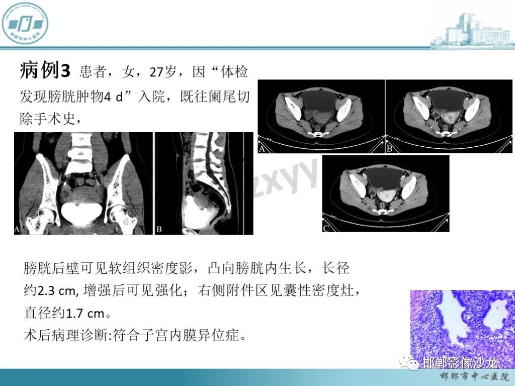 影像PPT - 【PPT】膀胱子宫内膜异位症-21 影像PPT - 【PPT】膀胱子宫内膜异位症-21