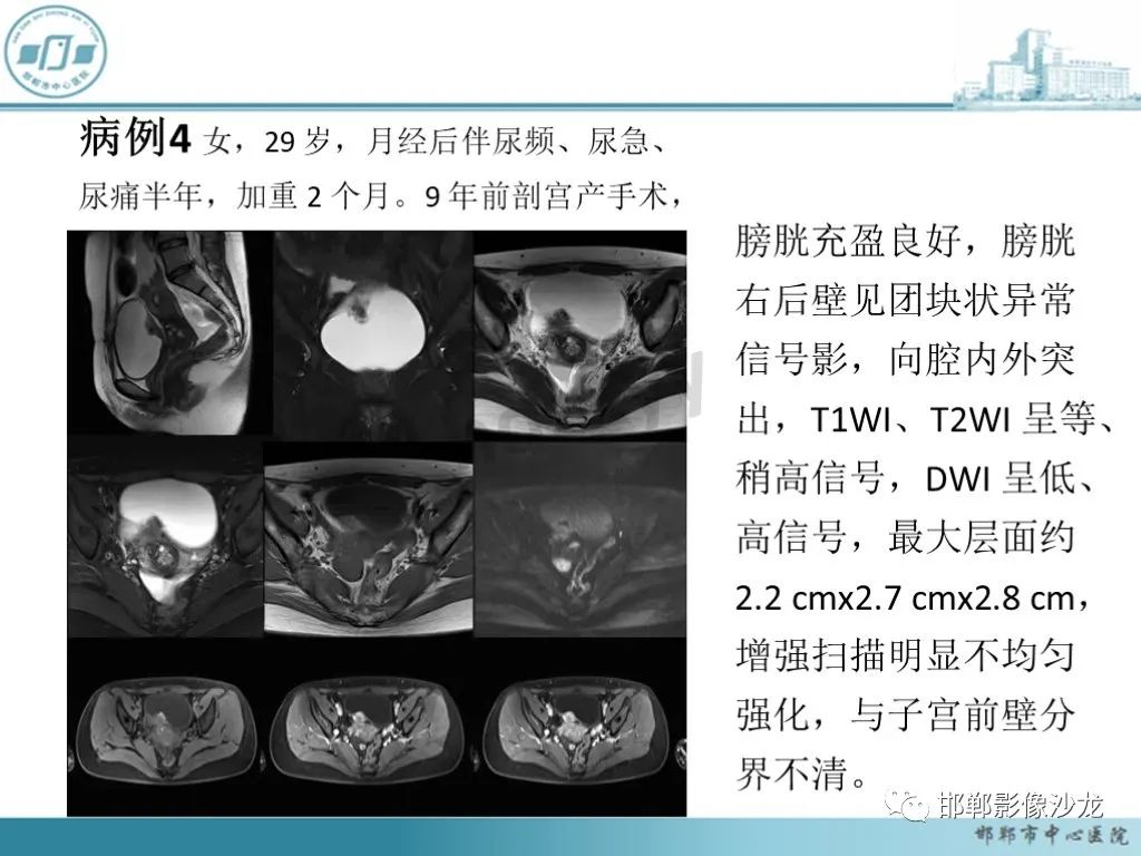 影像PPT - 【PPT】膀胱子宫内膜异位症-22 影像PPT - 【PPT】膀胱子宫内膜异位症-22
