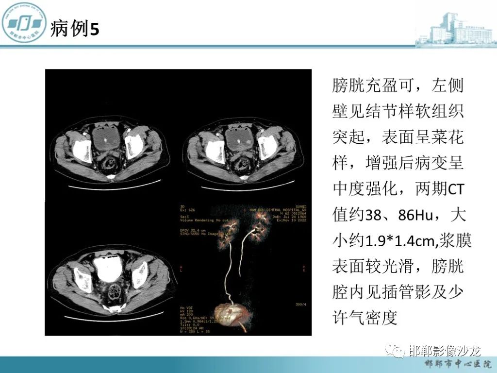 影像PPT - 【PPT】膀胱子宫内膜异位症-27 影像PPT - 【PPT】膀胱子宫内膜异位症-27