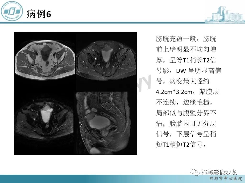 影像PPT - 【PPT】膀胱子宫内膜异位症-29 影像PPT - 【PPT】膀胱子宫内膜异位症-29