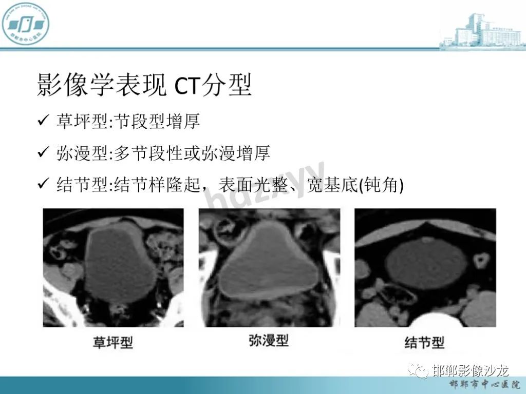 影像PPT - 【PPT】膀胱子宫内膜异位症-34 影像PPT - 【PPT】膀胱子宫内膜异位症-34