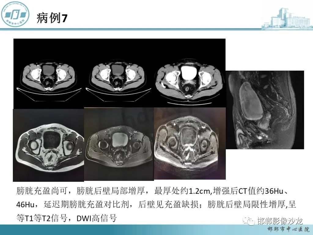 影像PPT - 【PPT】膀胱子宫内膜异位症-36 影像PPT - 【PPT】膀胱子宫内膜异位症-36