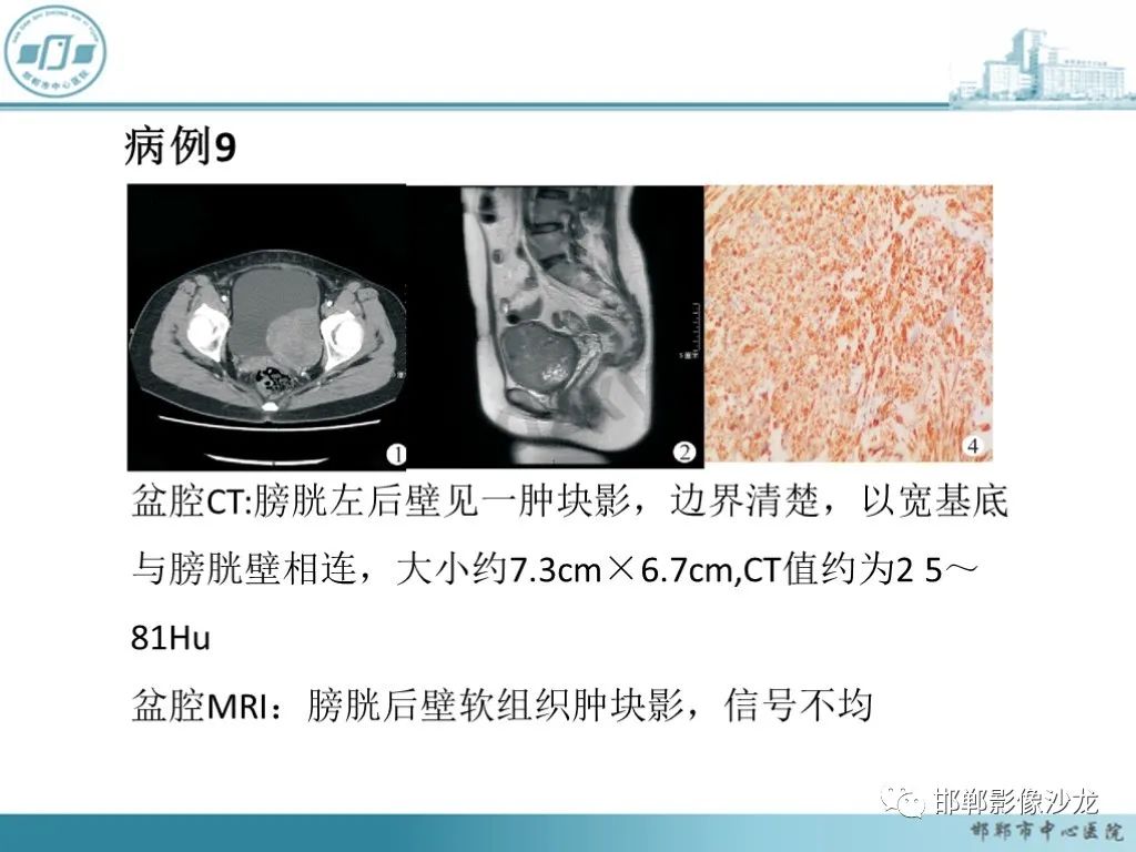 影像PPT - 【PPT】膀胱子宫内膜异位症-40 影像PPT - 【PPT】膀胱子宫内膜异位症-40