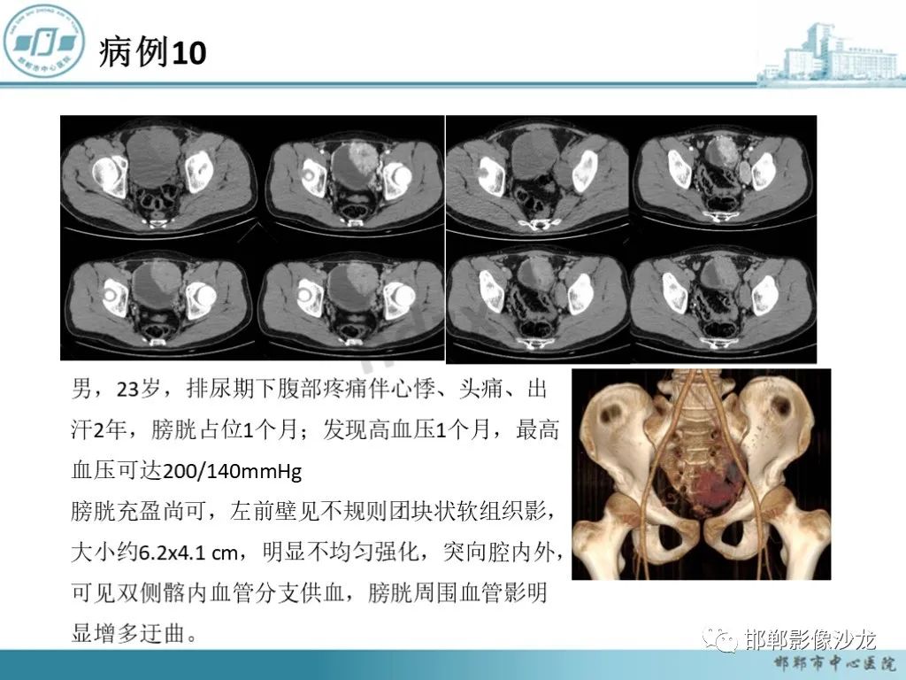 影像PPT - 【PPT】膀胱子宫内膜异位症-43 影像PPT - 【PPT】膀胱子宫内膜异位症-43