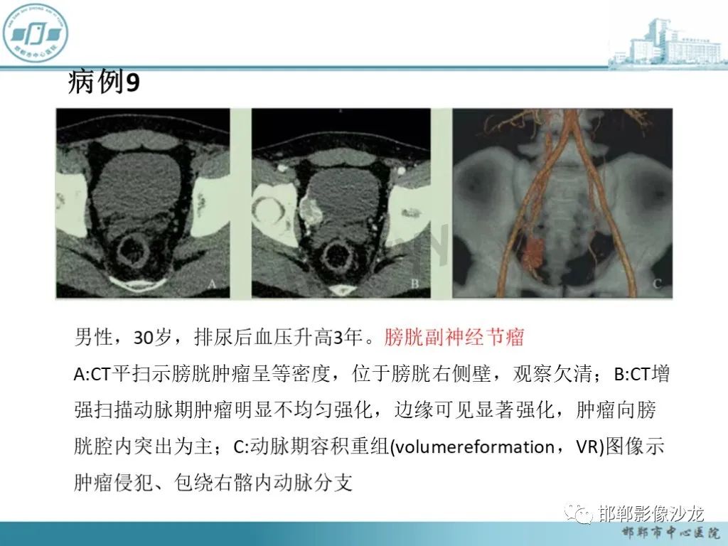 影像PPT - 【PPT】膀胱子宫内膜异位症-44 影像PPT - 【PPT】膀胱子宫内膜异位症-44