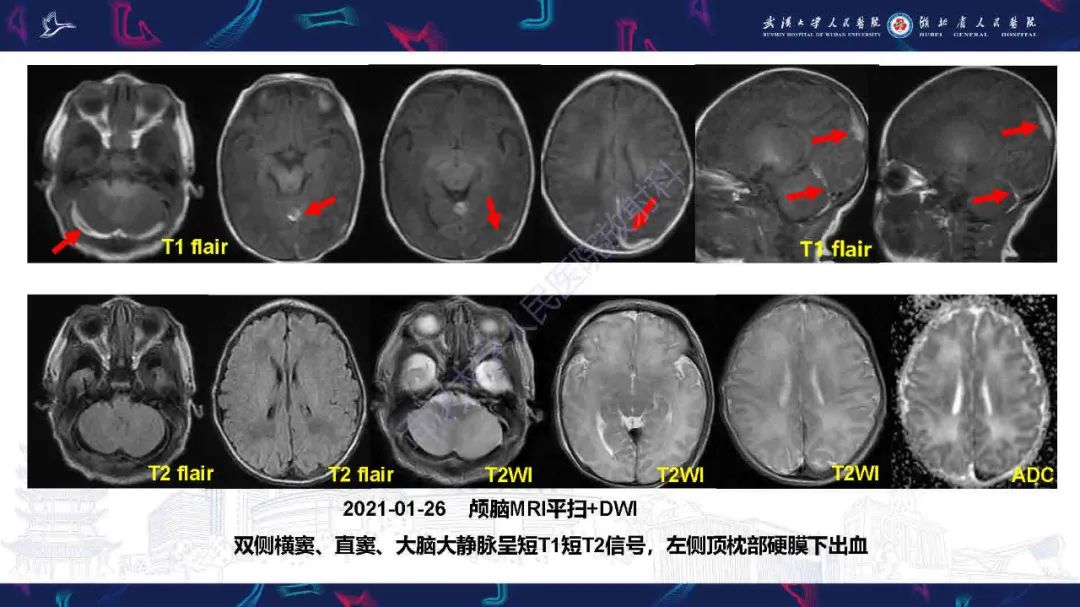 影像PPT - 【PPT】儿童脑静脉病变影像诊断-4
