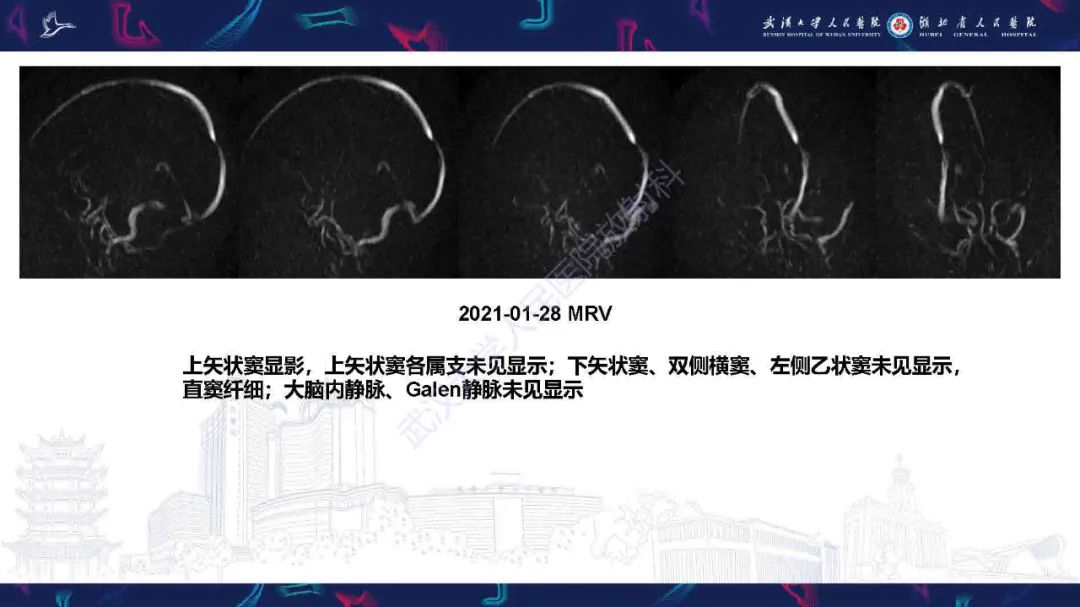 影像PPT - 【PPT】儿童脑静脉病变影像诊断-5