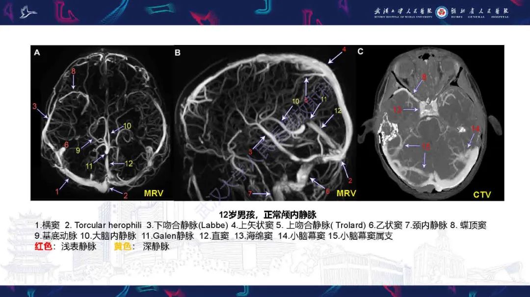 影像PPT - 【PPT】儿童脑静脉病变影像诊断-16