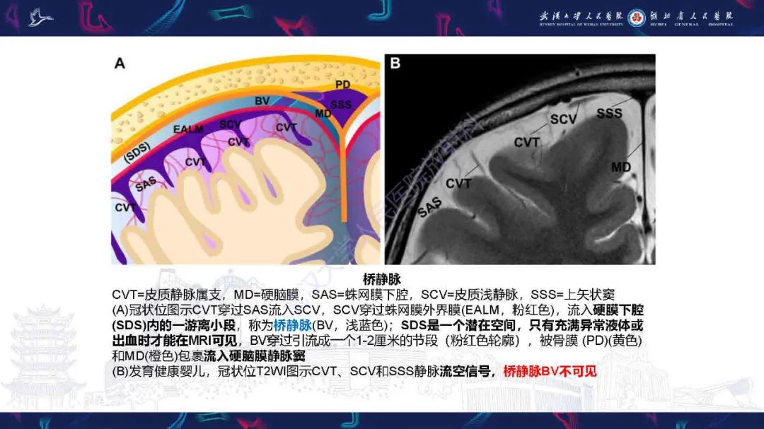 影像PPT - 【PPT】儿童脑静脉病变影像诊断-18