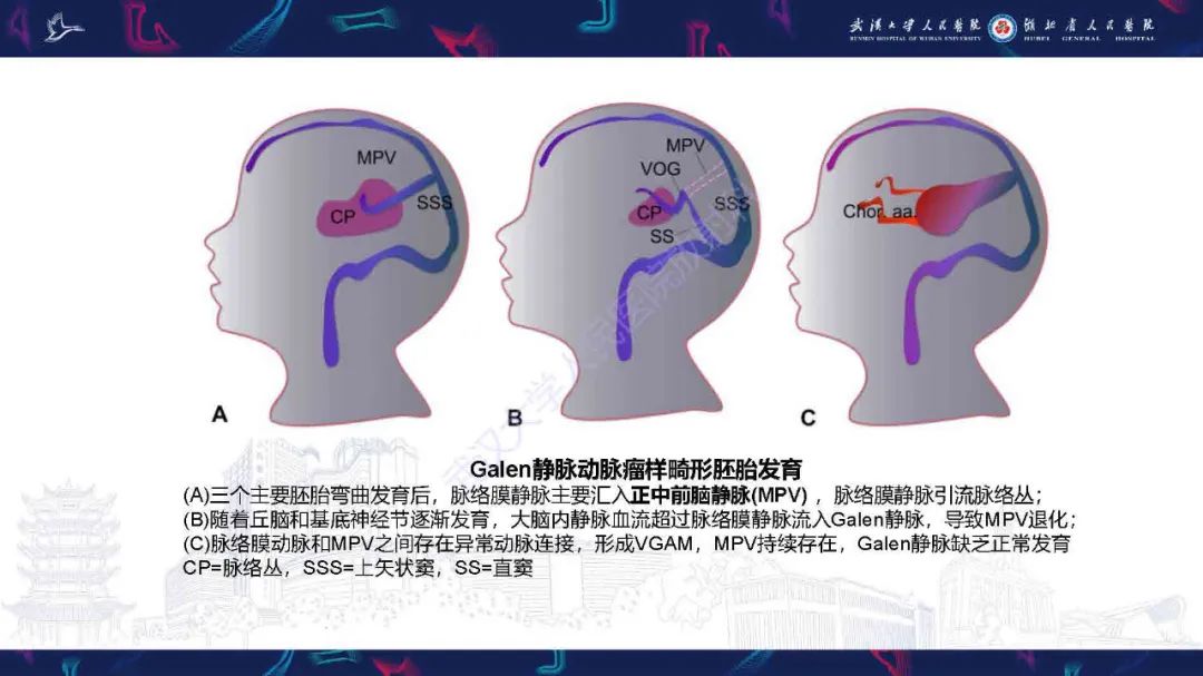 影像PPT - 【PPT】儿童脑静脉病变影像诊断-26