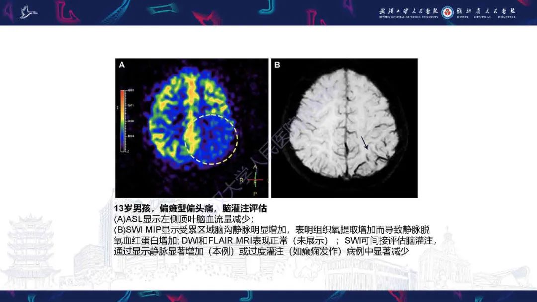 影像PPT - 【PPT】儿童脑静脉病变影像诊断-29